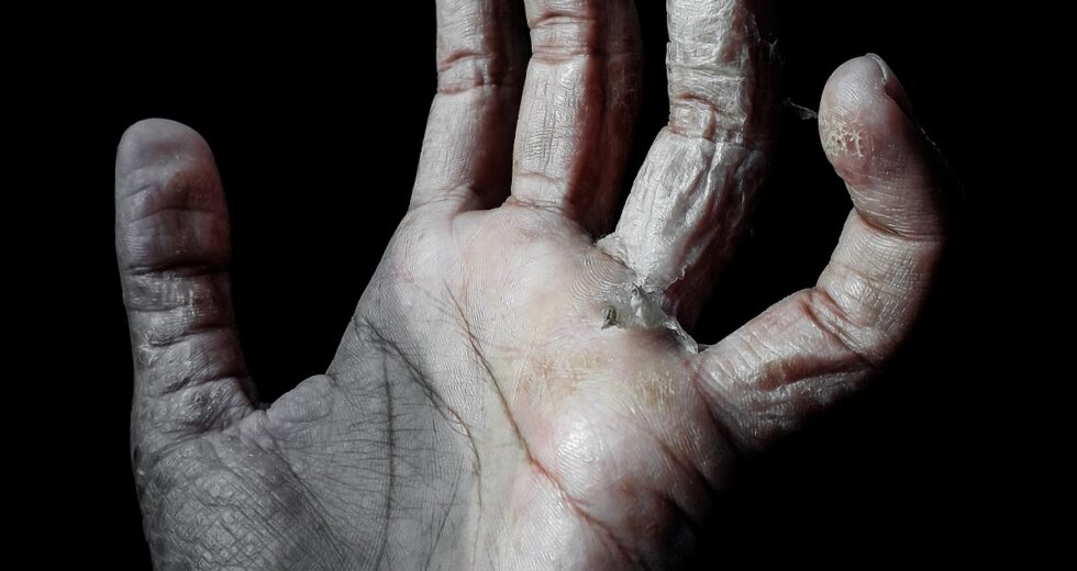 Leprosy Could Soon Turn Into the Worst-case Scenario in Central Florida