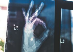 Fighting Myeloma With Breakthrough Trial; Better Diagnosis and Treatment Are Expected