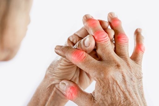 Research Finds Existing Drug Could Help People With Painful Hand Osteoarthritis