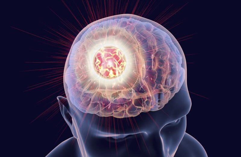 3rd Gen Targeted Therapy Controls Brain Metastasis in Non-Small Cell Lung Cancer