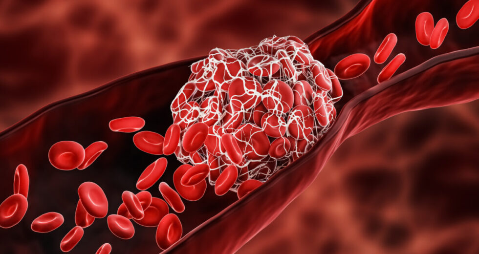 Blood Clot Risk Rapidly Drops Following Stopping Contraception