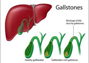 Connection Between Gallbladder Disease And Holiday Meals