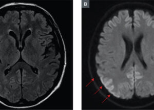 Cases of Creutzfeldt-Jakob Disease Are Rising