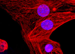 First Ever CRISPR Gene-Editing Therapy Has Been Just Approved in the US