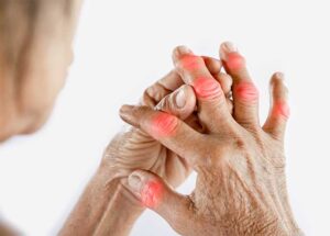 Popular Arthritis Supplement Brings Huge Health Benefits
