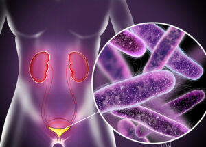 Pain From UTIs Doesn’t Stop After Antibiotics; Here’s Why