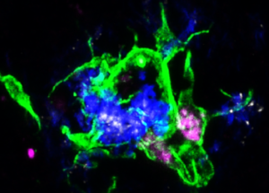 Experimental Alzheimer’s Immunotherapy, A New Hope For Treatment