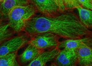 Navigating Breast Cancer: Understanding Its Stages and Grades